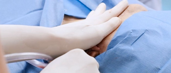 Upper Blepharoplasty While Awake! - 24