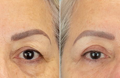 blepharoplasty-01-09.26-img1