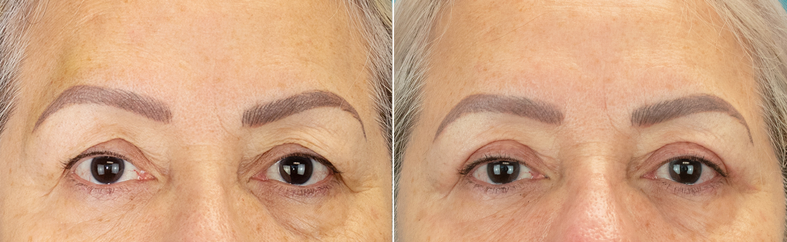 Blepharoplasty