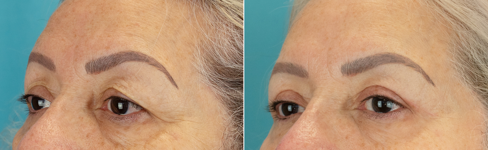 Blepharoplasty