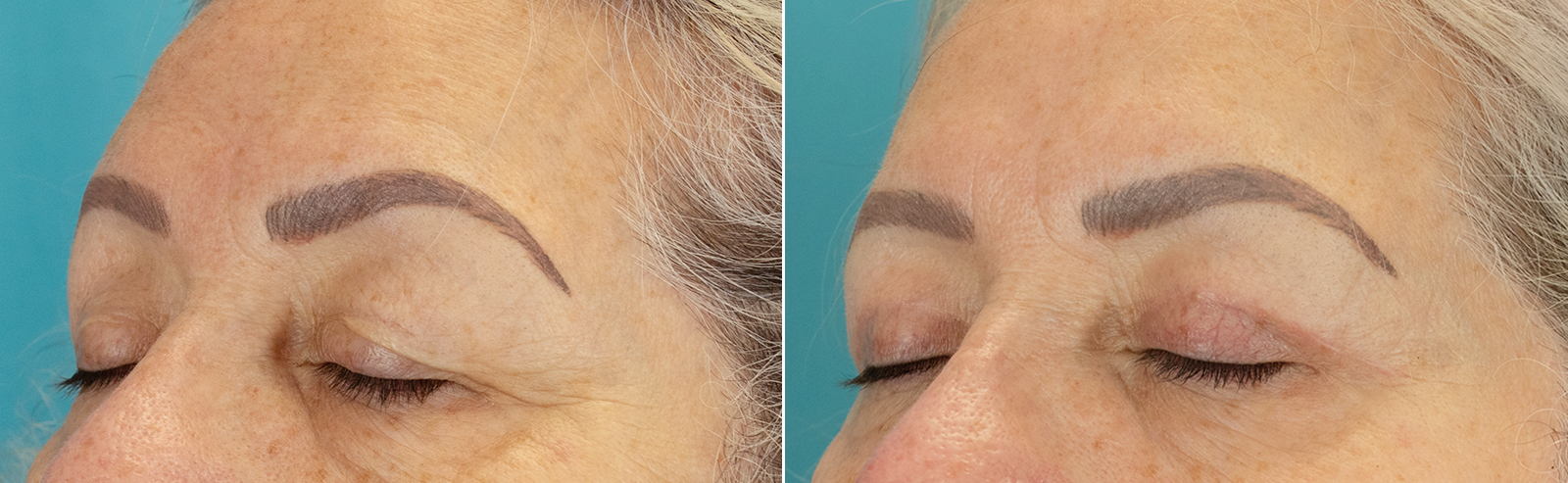 Blepharoplasty