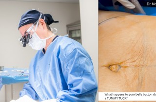 Upper Blepharoplasty While Awake! - 4