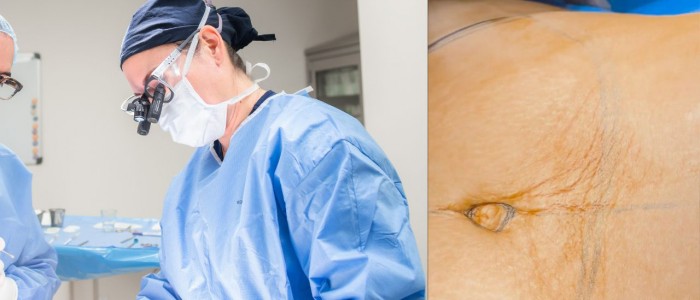 Upper Blepharoplasty While Awake! - 4