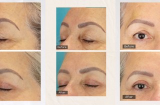 Upper Blepharoplasty While Awake! - 15