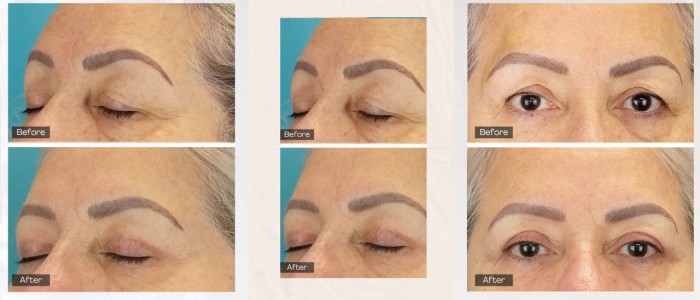 Upper Blepharoplasty While Awake! - 15