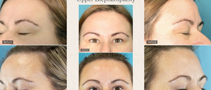 Breast Augmentation - 2