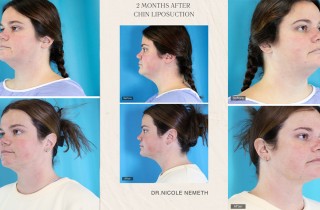 chin-lip-before-after-cover