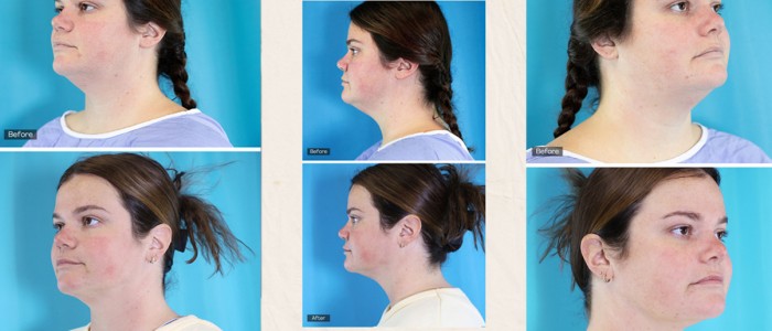 chin-lip-before-after-cover