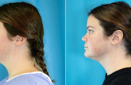 chin-liposuction-7.15.26-img1