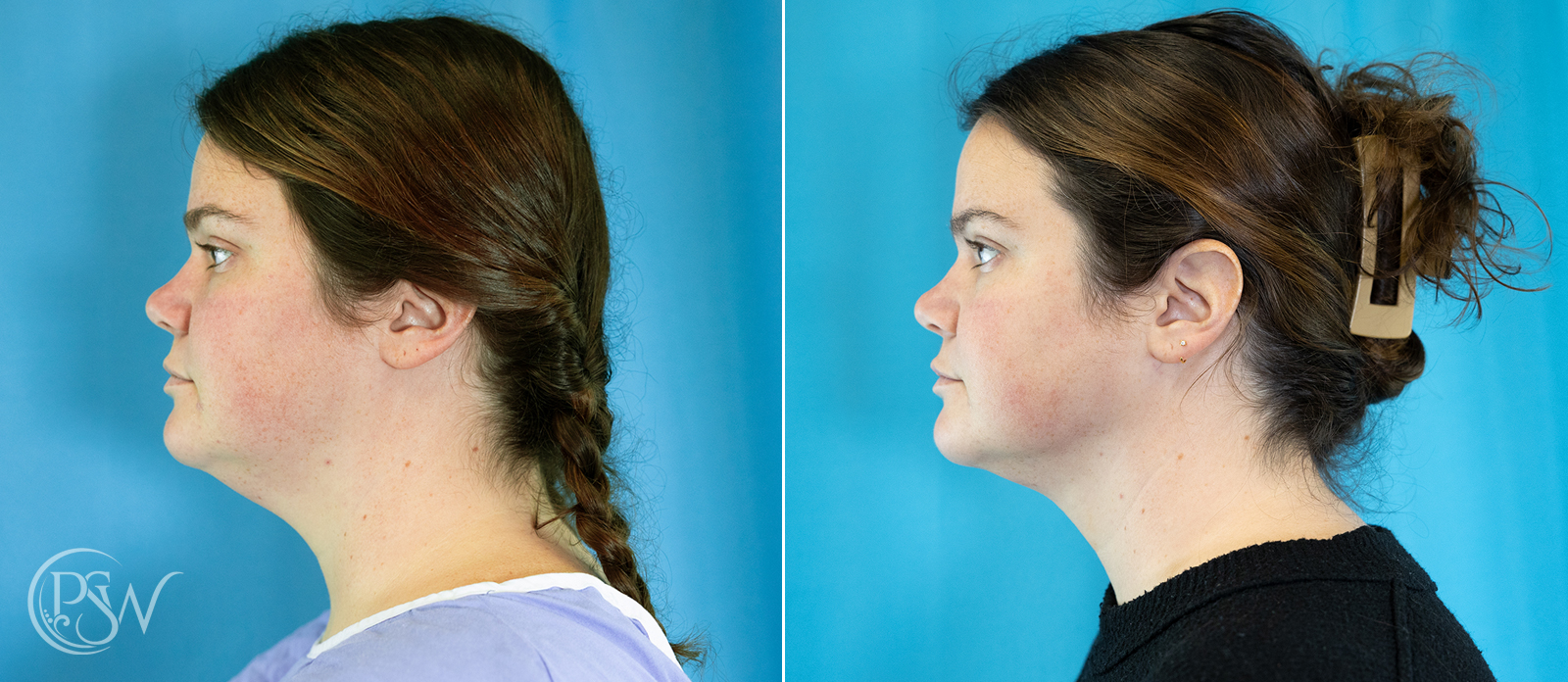chin-liposuction