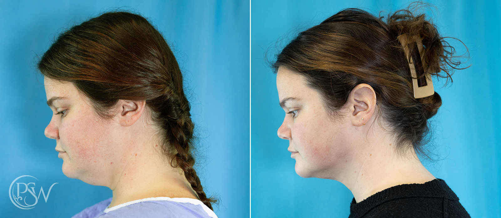 chin-liposuction