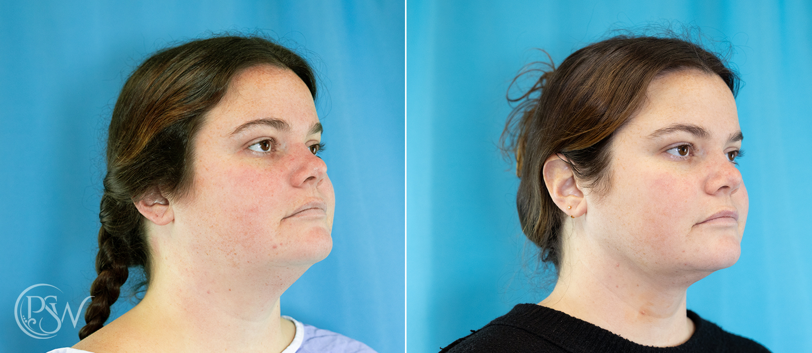 chin-liposuction