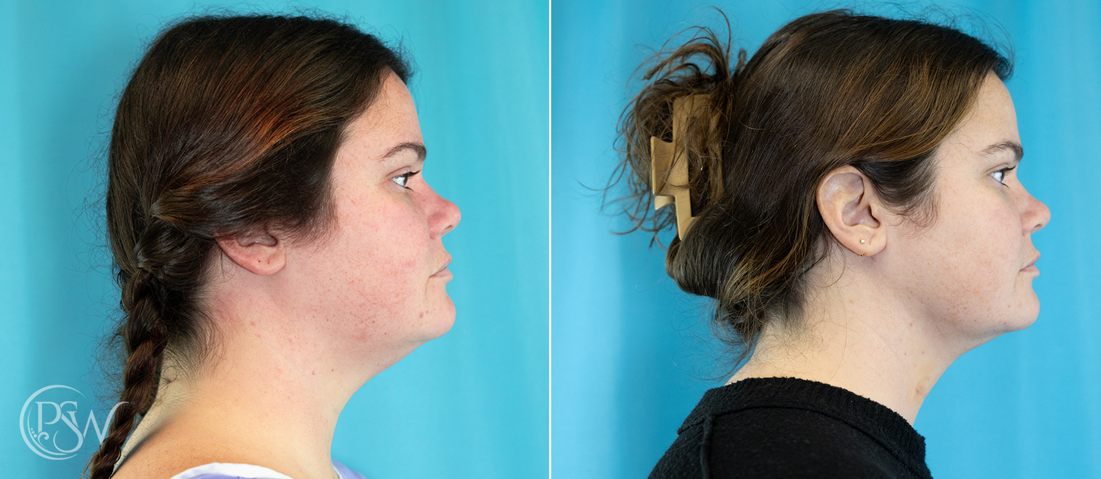 chin-liposuction