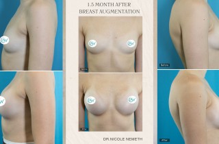 dr-nemeth-before-after-breast-aug-cover