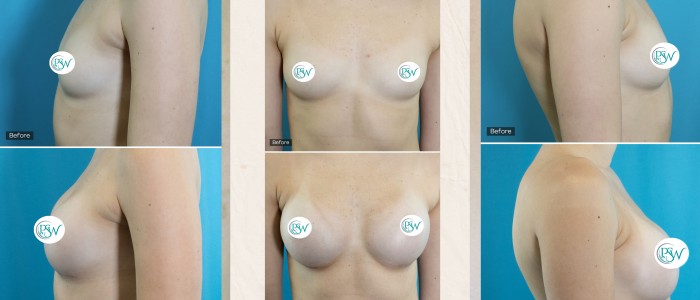 dr-nemeth-before-after-breast-aug-cover