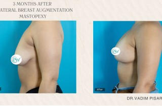 Breast Augmentation - 3