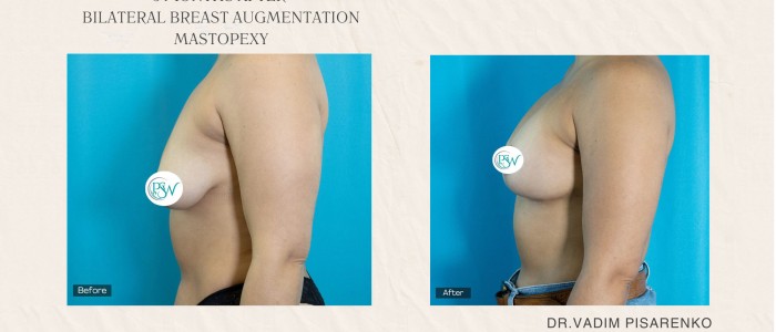 Breast Augmentation - 3