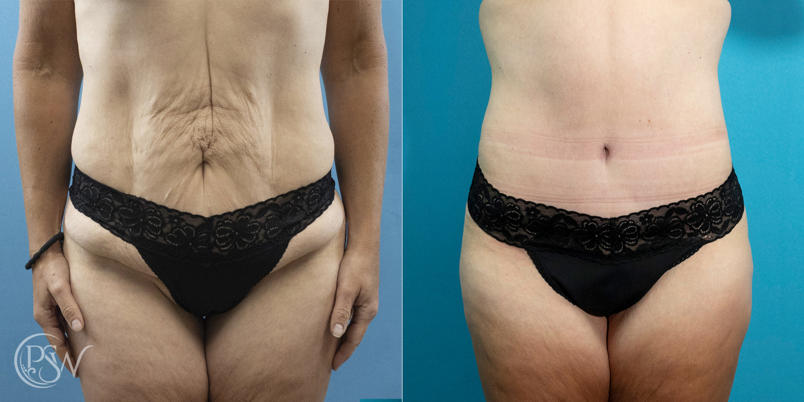 tummy-tuck