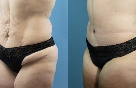 abdominoplasty-08-15-26-2