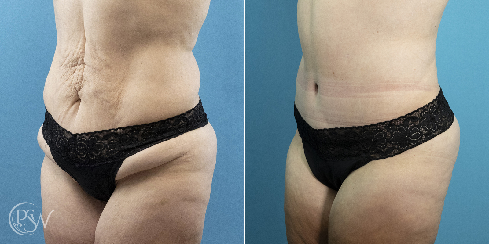 tummy-tuck