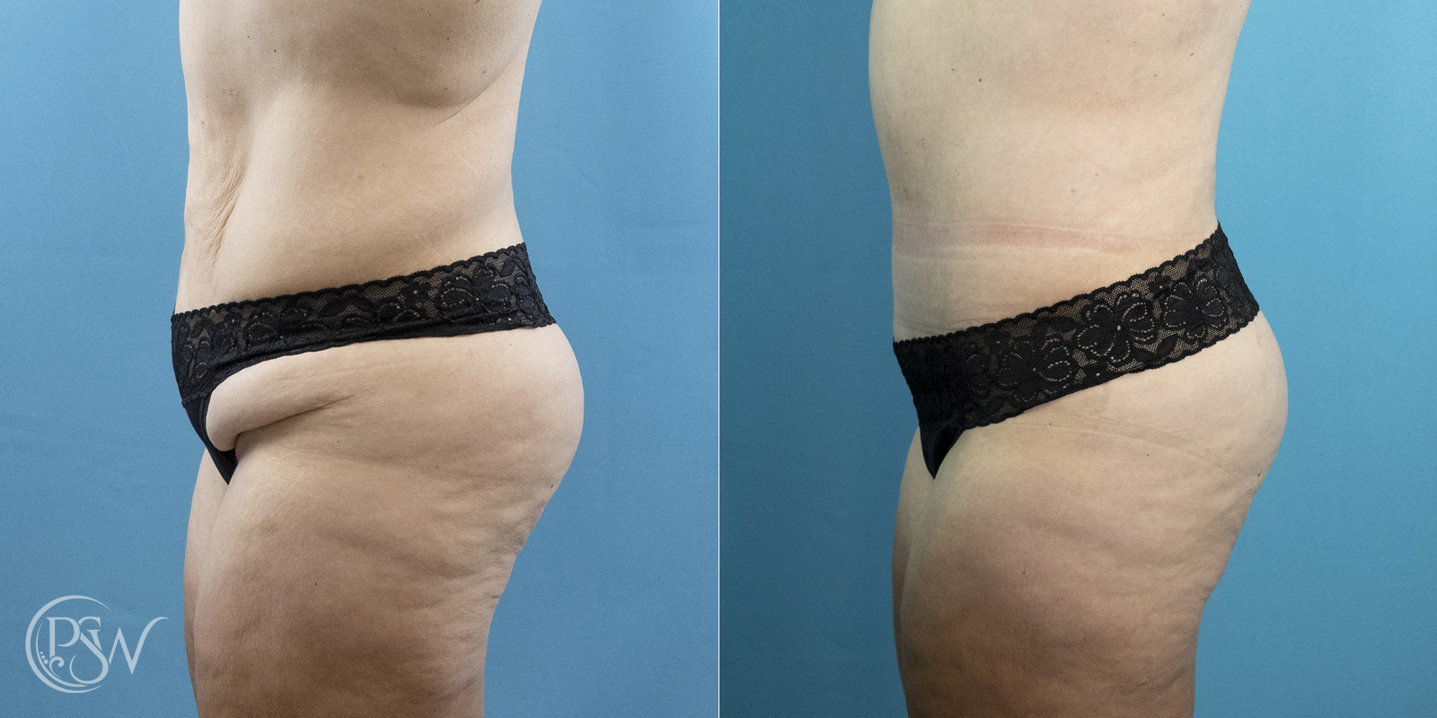 tummy-tuck
