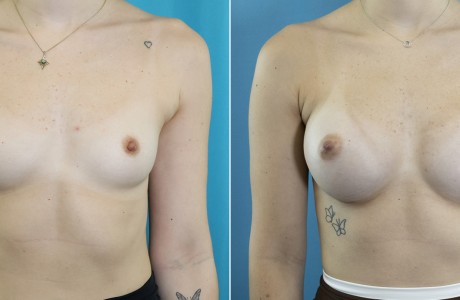 breast-aug-08-15-26-1