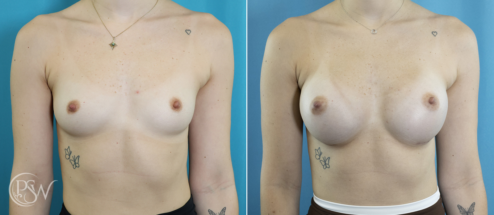 breast-augmentation