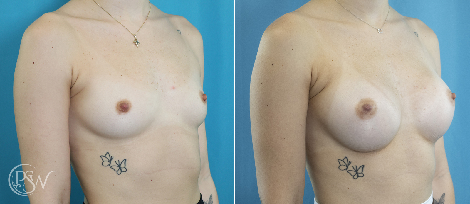 breast-augmentation