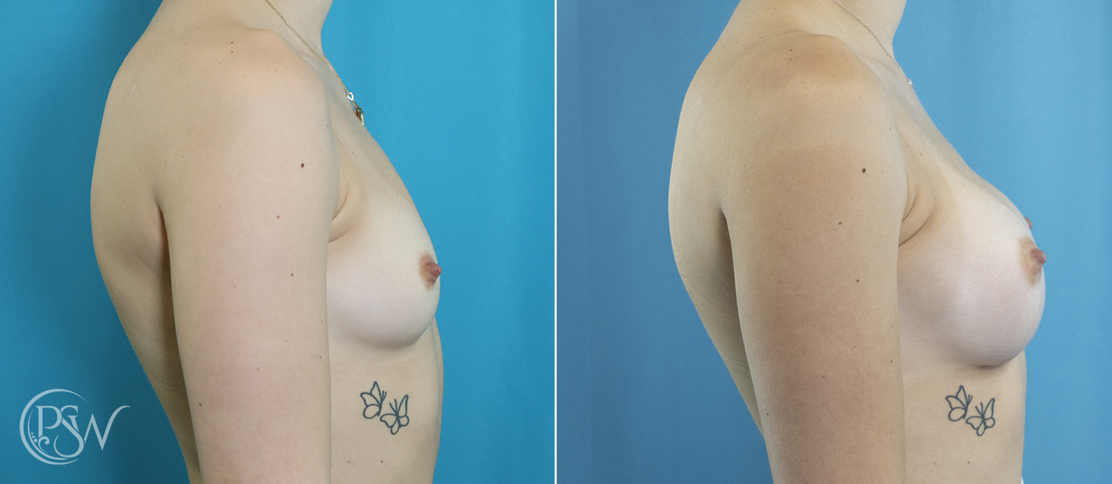 breast-augmentation