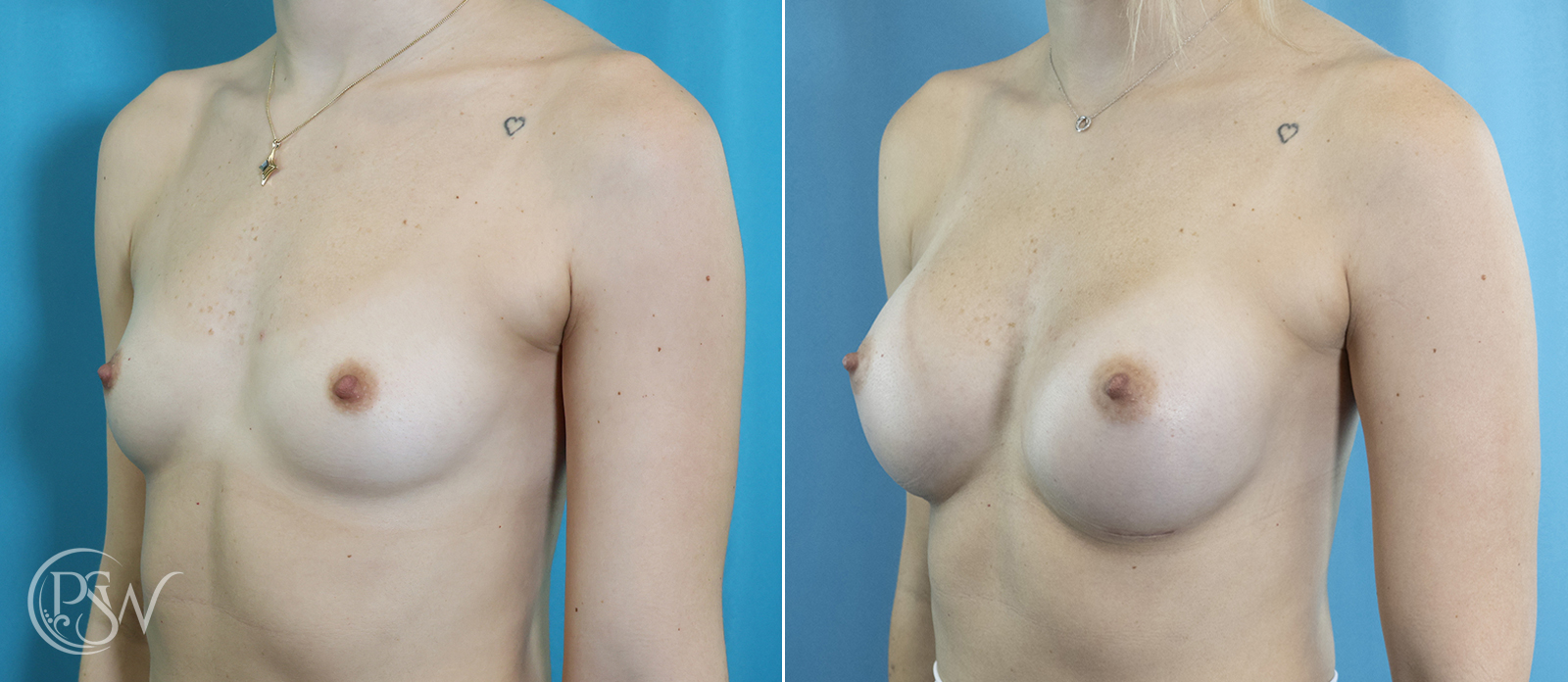 breast-augmentation