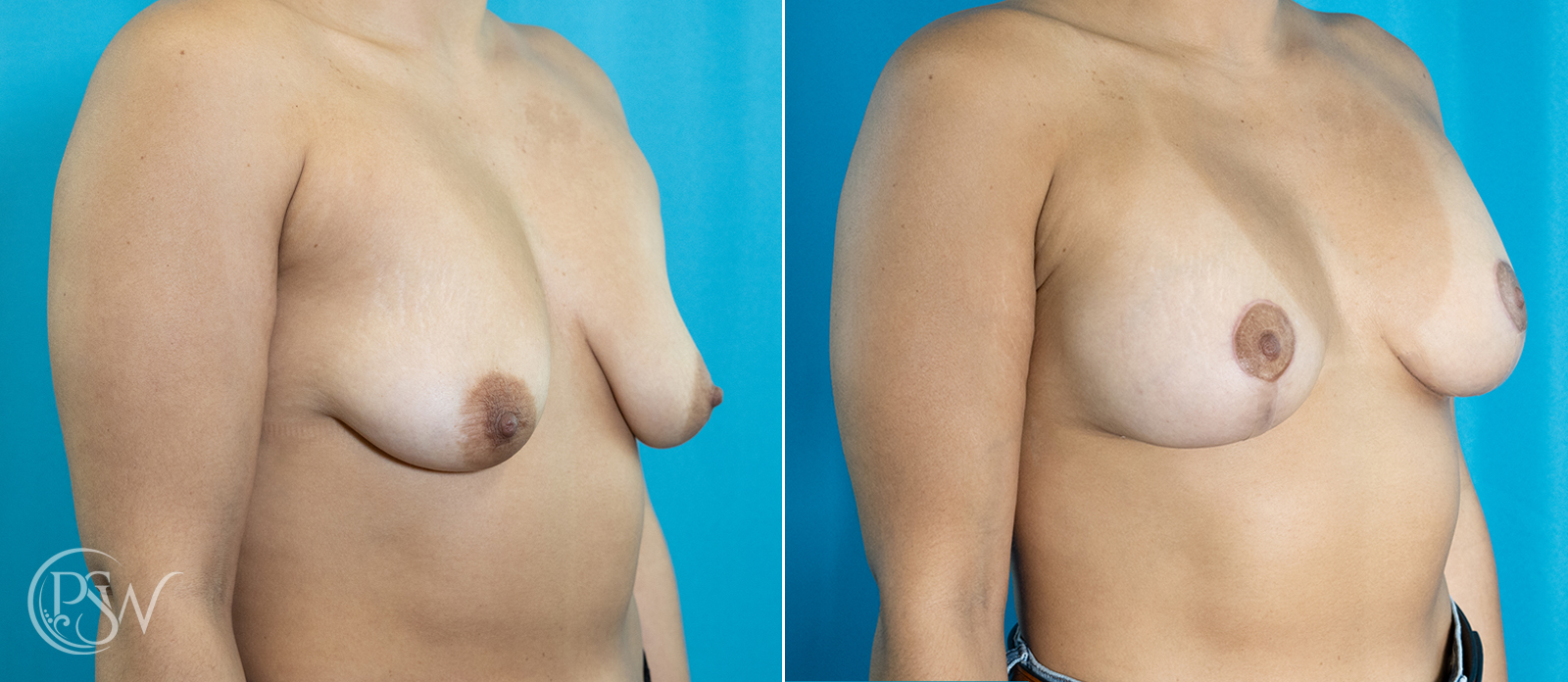 breast-augmentation and lift